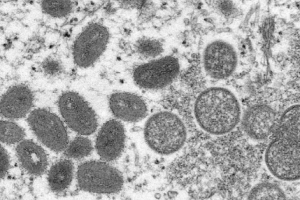 ABD’de monkeypox (maymun çiçeği) virüsü alarmı