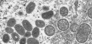 ABD’de monkeypox (maymun çiçeği) virüsü alarmı